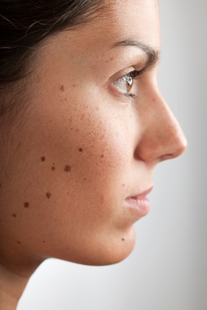 hyperpigmentation